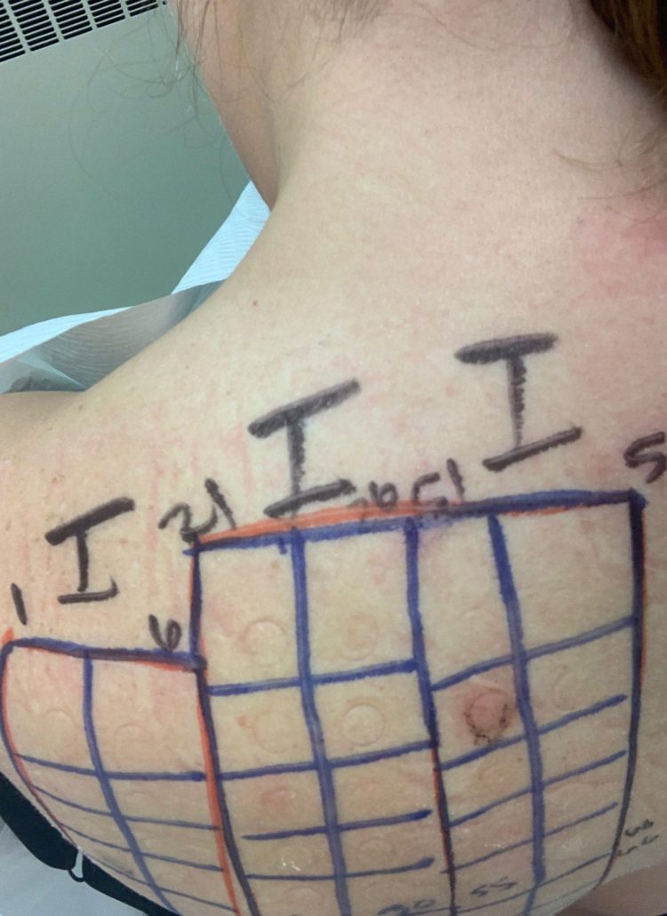 image of the back where a grid is drawn to show where patches had been placed during a patch test