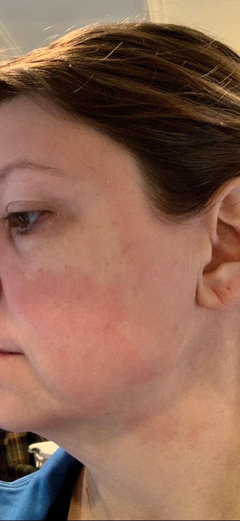 picture of red welts on cheek