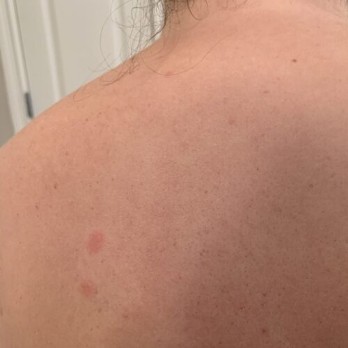 What is a patch test? - The Allergy Life